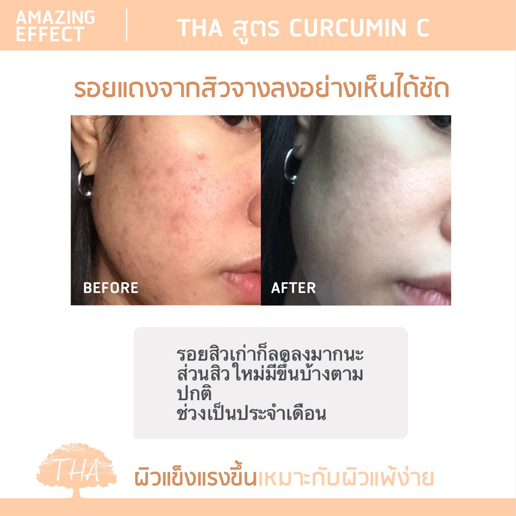 รีวิวครีมฑา รอยสิว